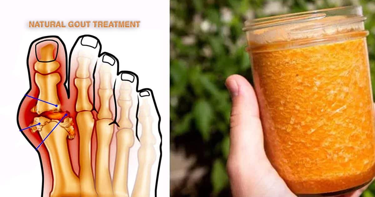 Treat Gout With This All Natural 3Ingredient Recipe