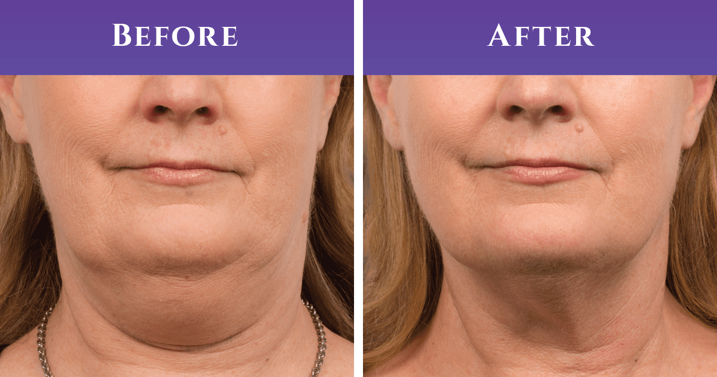 The Best Double Chin Exercises For Your Fat Face 2022