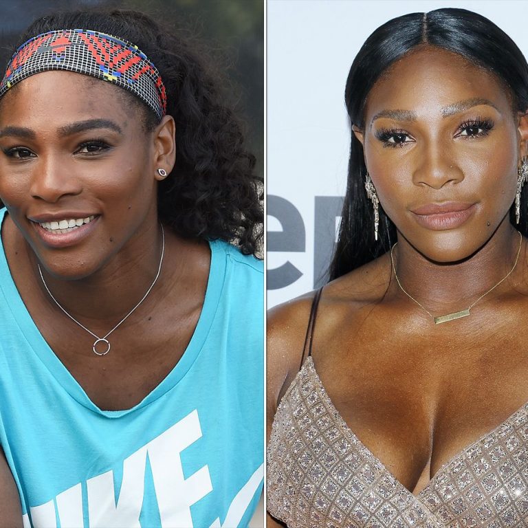Serena Williams Plastic Surgery Before & After 2022